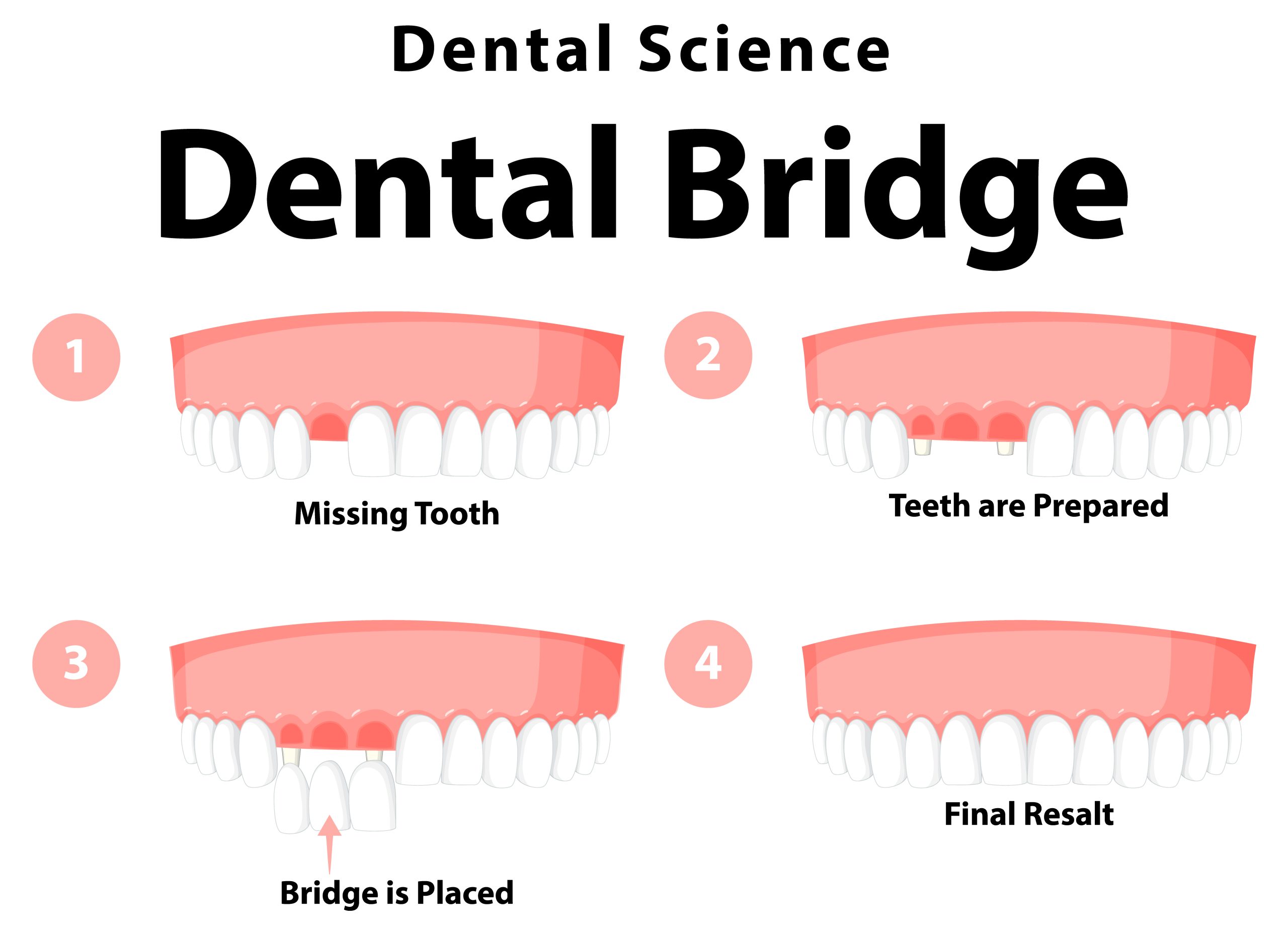 dental bridges in niagara falls