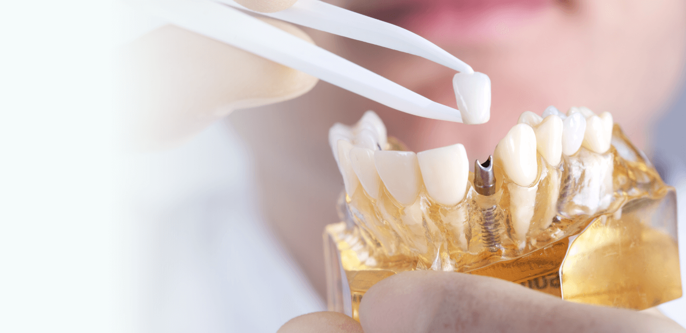 dental implants niagara falls