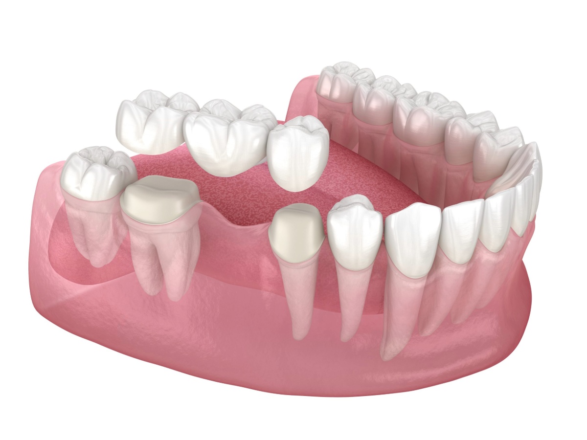 types of dental bridges niagara falls