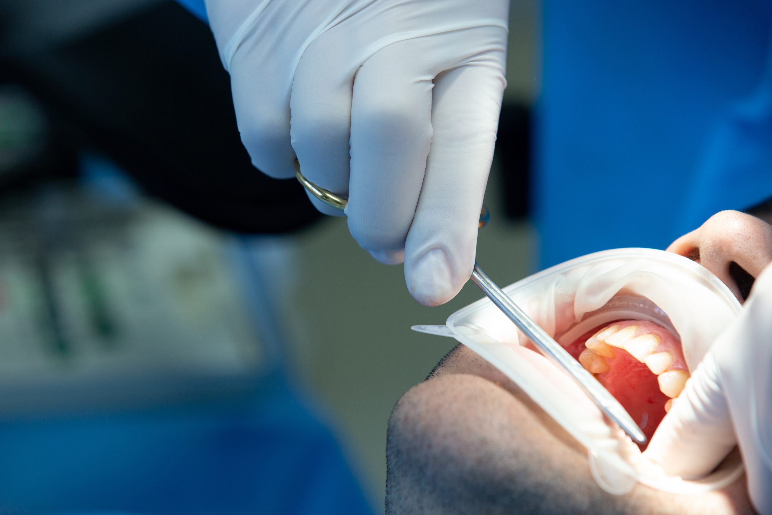 wisdom tooth removal what to expect