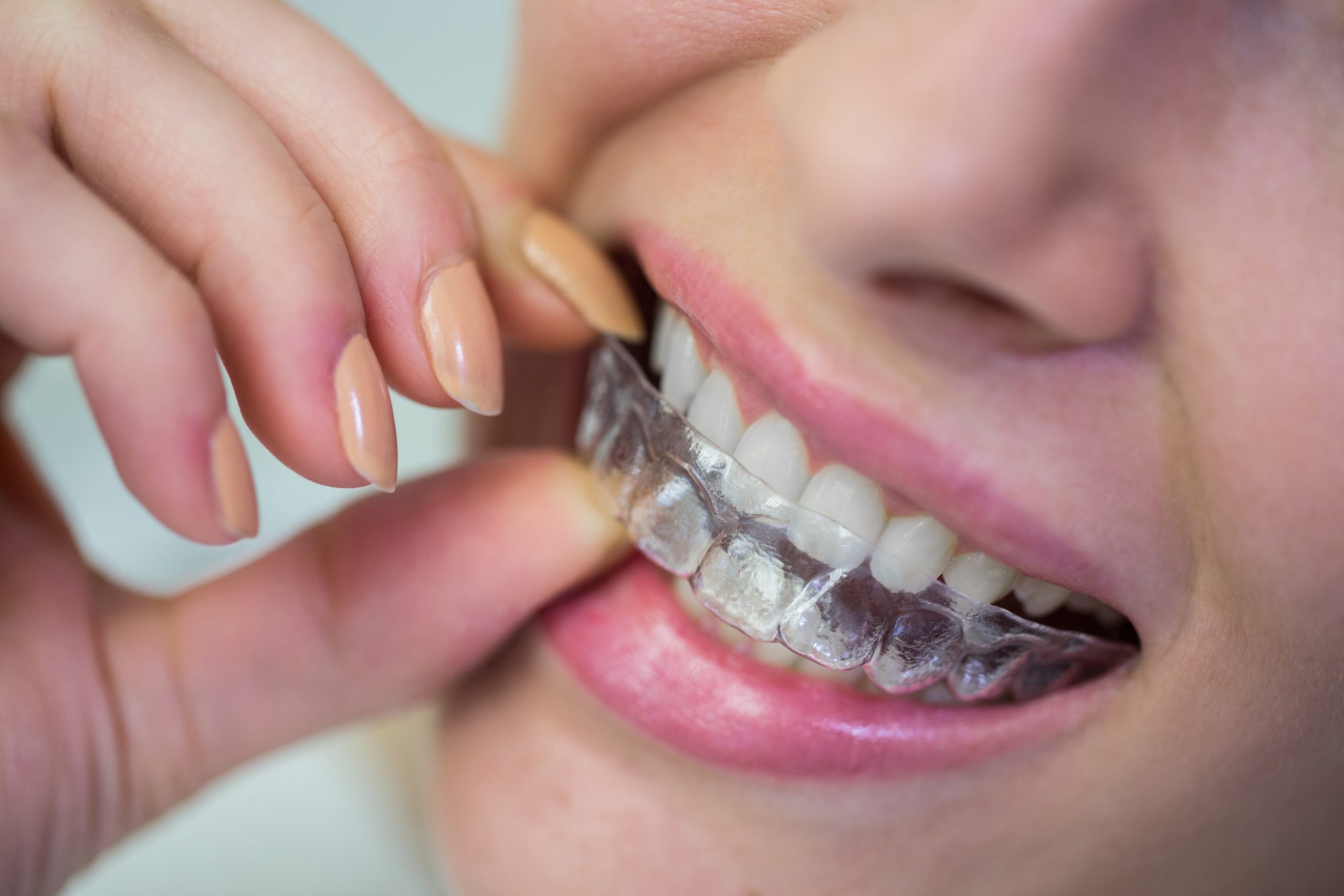 How Long Does Invisalign Take to Deliver a Straighter Smile?
